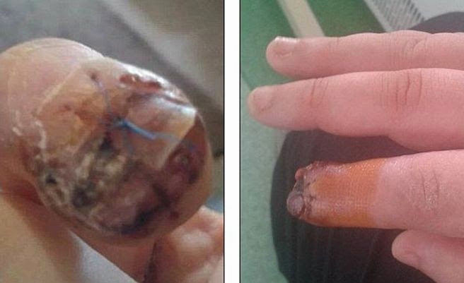 La enfermedad de las uñas en las manos ondulado el tratamiento